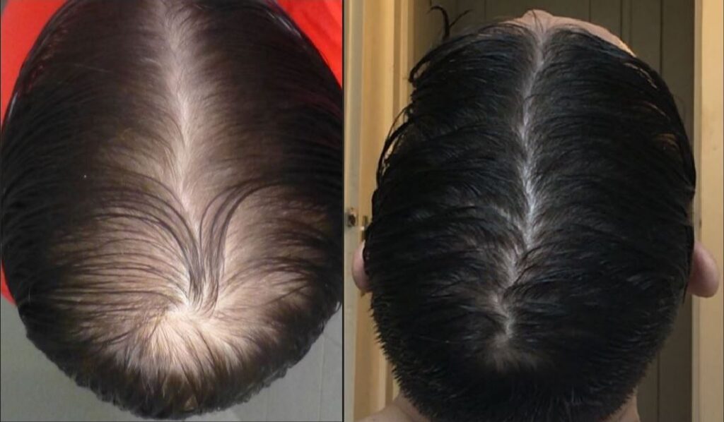 Finasterid vorhher nachher Vergleichsbild Finasterid vorher nachher Vergleichsbild, Haarverlust vorher nachher