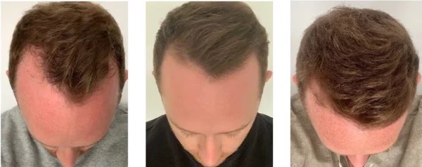 Finasterid vorhher nachher Vergleichsbild Finasterid vorher nachher Vergleichsbild, Haarverlust vorher nachher
