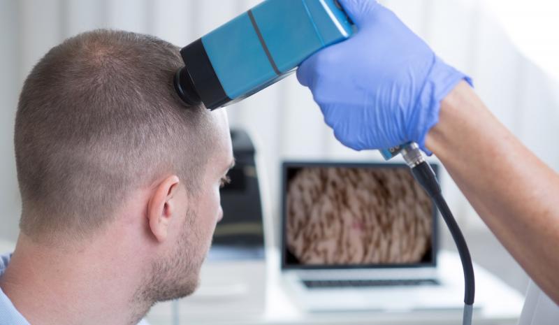 Untersuchungsmethoden Haarausfall Trichoscan der Kopfhaut, Ärztliche Diagnose bei Haarausfall