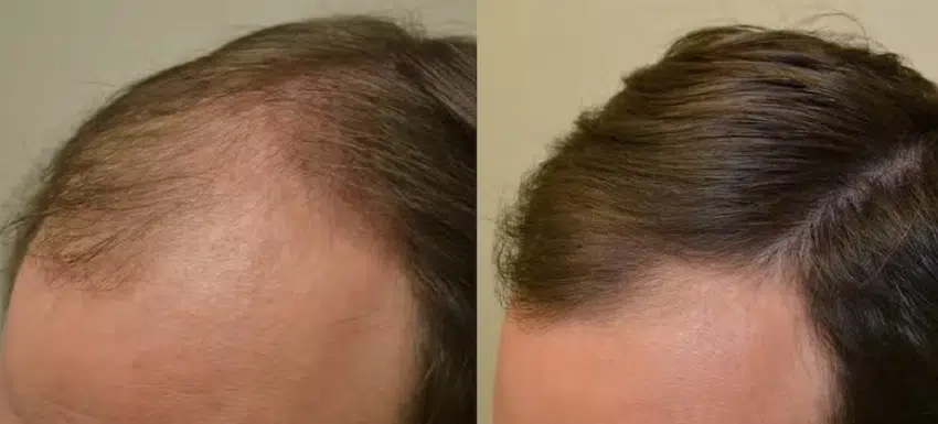 Finasterid vorhher nachher Vergleichsbild Finasterid vorher nachher Vergleichsbild, Haarverlust vorher nachher