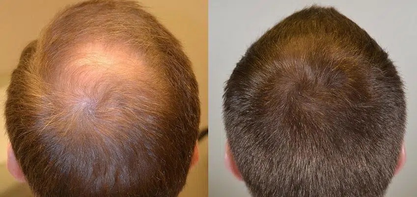Finasterid vorhher nachher Vergleichsbild Finasterid vorher nachher Vergleichsbild, Haarverlust vorher nachher