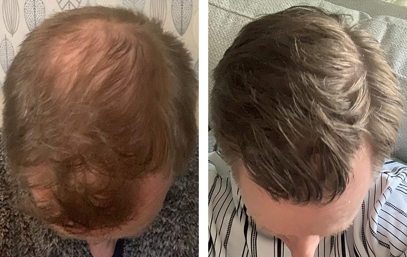 Finasterid Anwendung Finasterid 2 jahre Anwendung